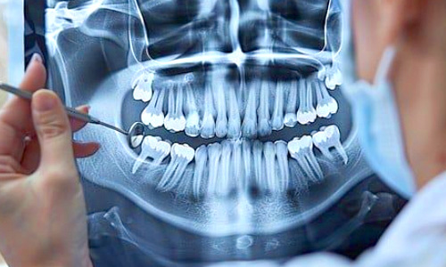 Dental X-ray OPG