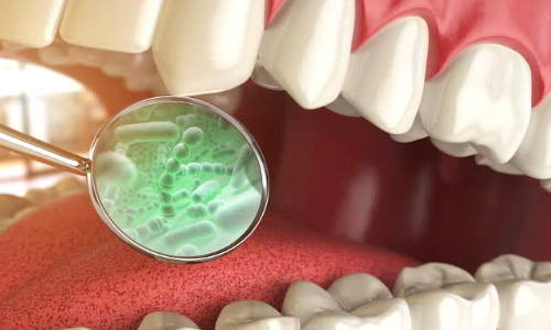 Oral Pathology