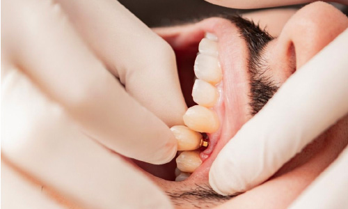 Periodontist and Implantation
