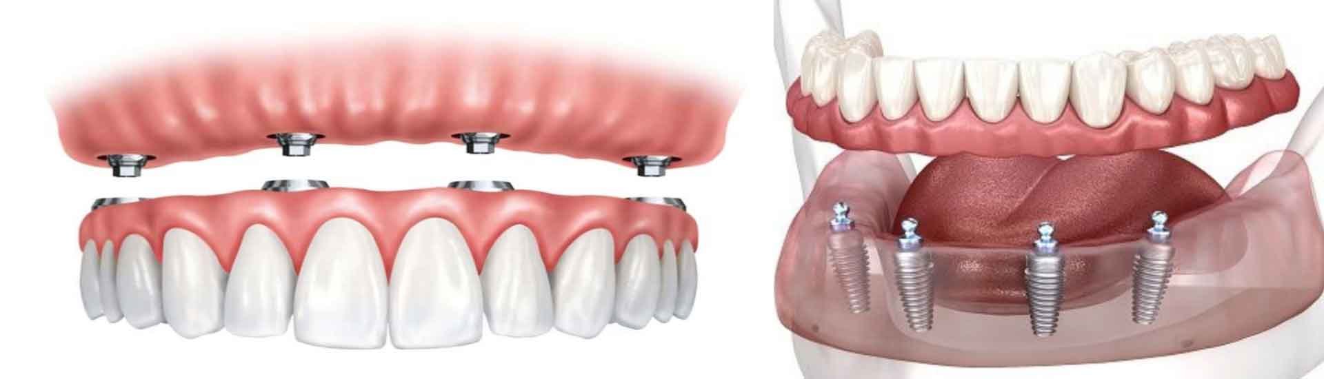 All-on-4 Dental Implants A Complete Guide